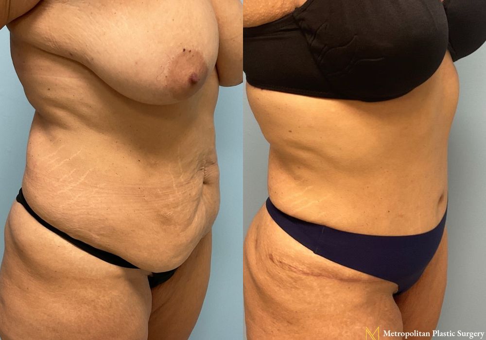 Abdominoplasty - Thumbnail 2