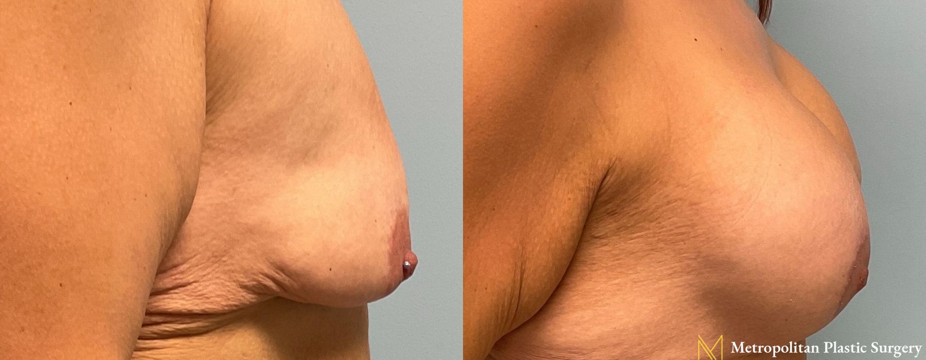 Breast Lift with Implants - Case 101
