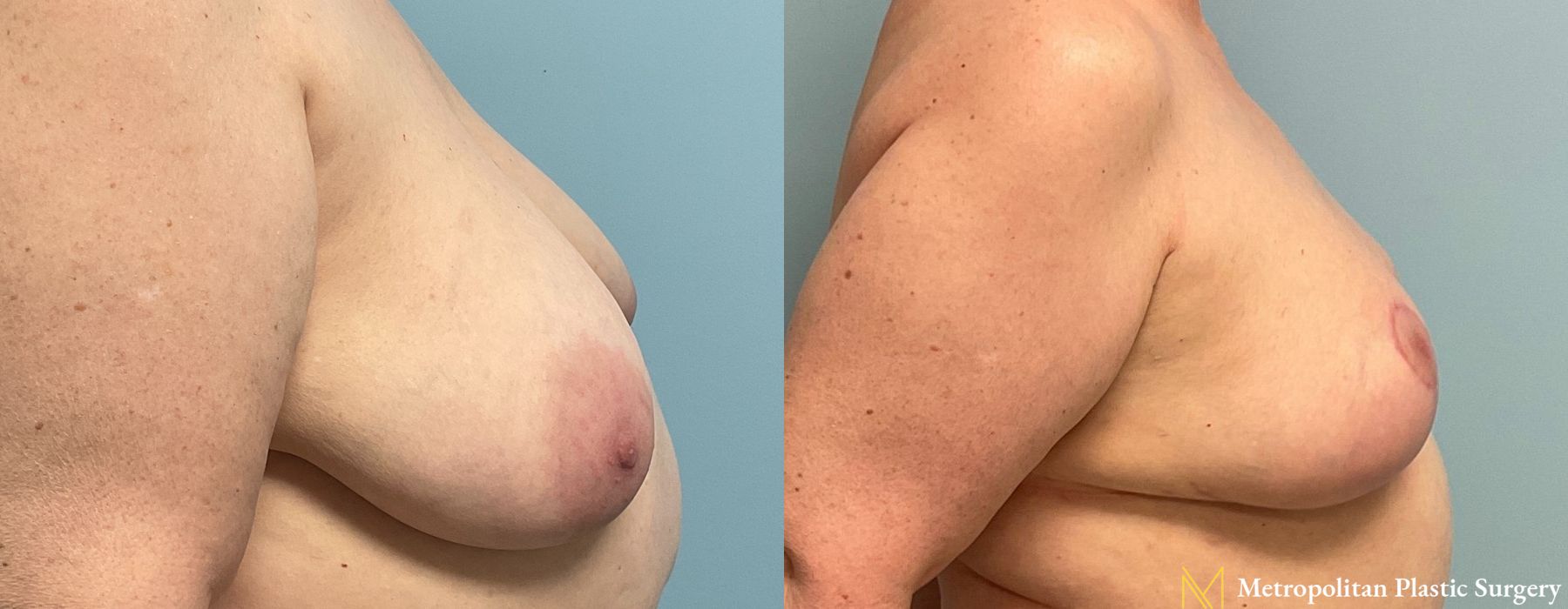 Breast Lift - Thumbnail 3