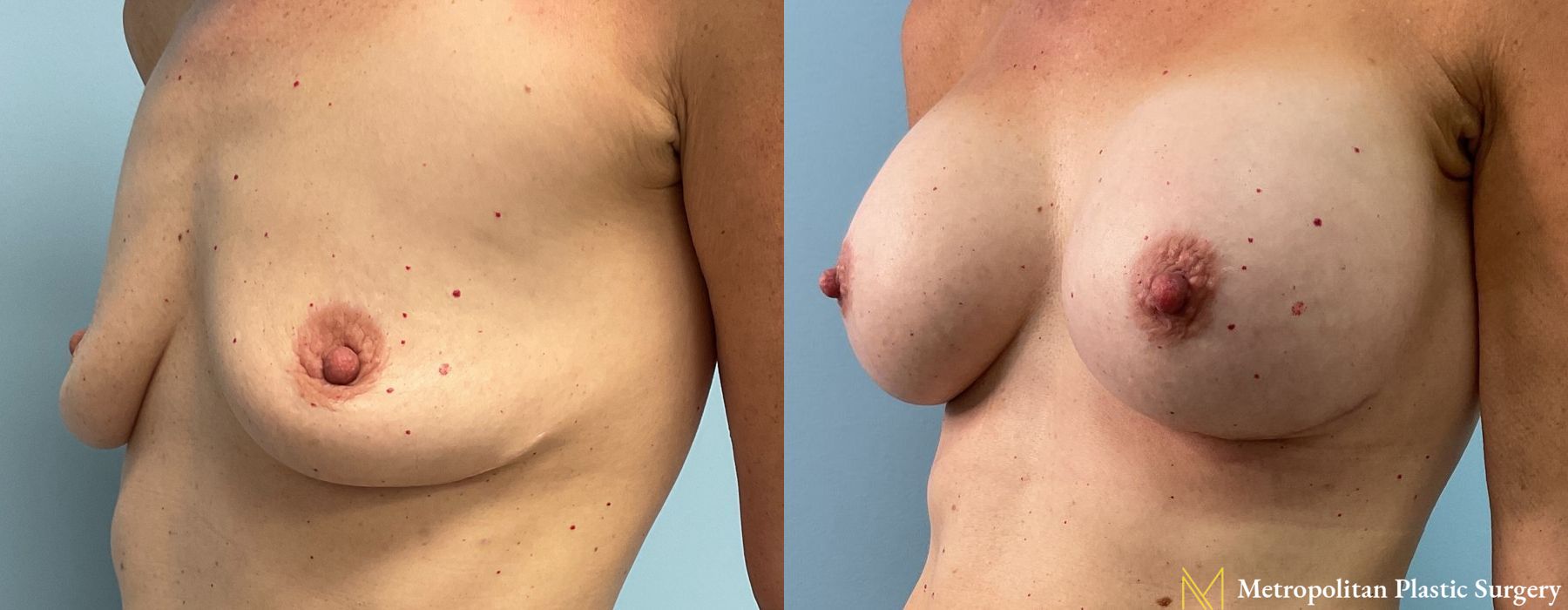 Breast Augmentation - Case 93
