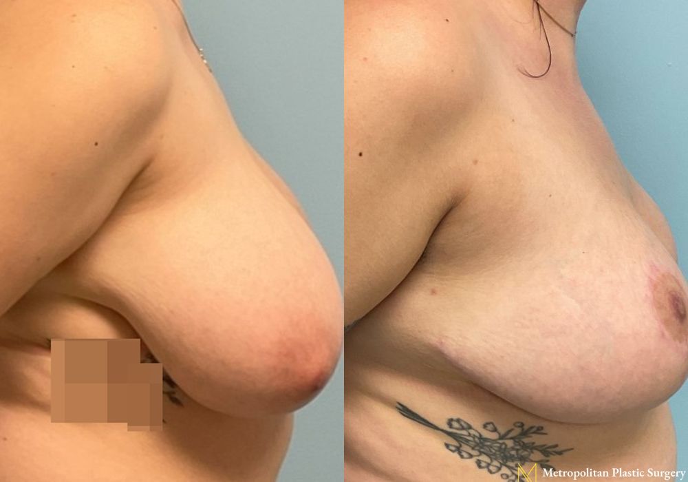 Breast Reduction - Case 108