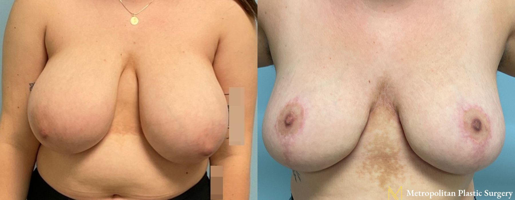 Breast Reduction - Thumbnail 3