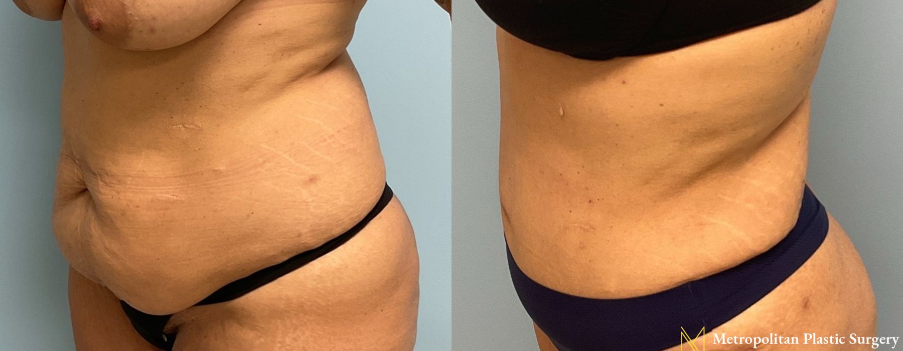 Liposuction - Thumbnail 5