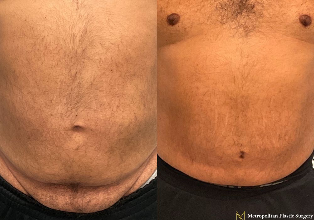 Liposuction - Case 212
