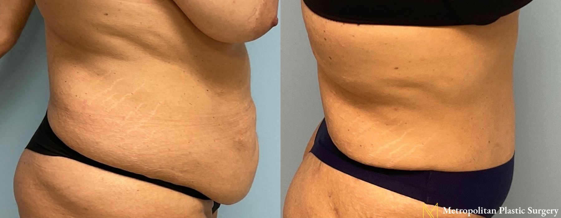 Liposuction - Thumbnail 2