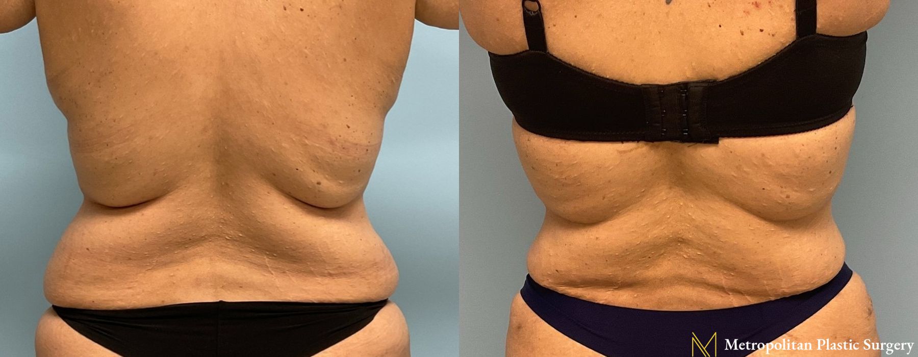 Liposuction - Thumbnail 6