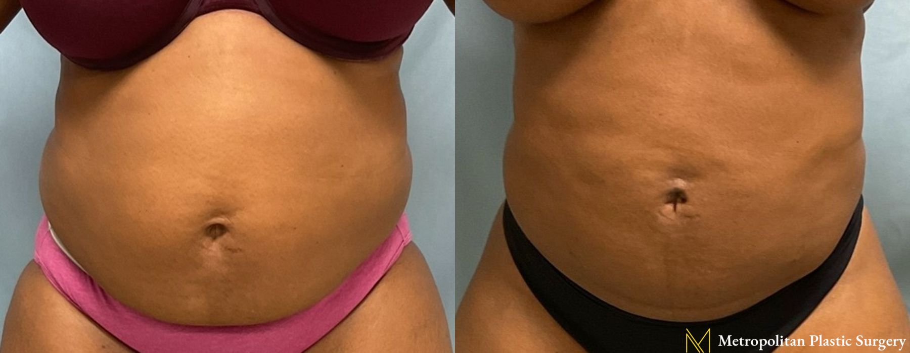 Liposuction - Case 208