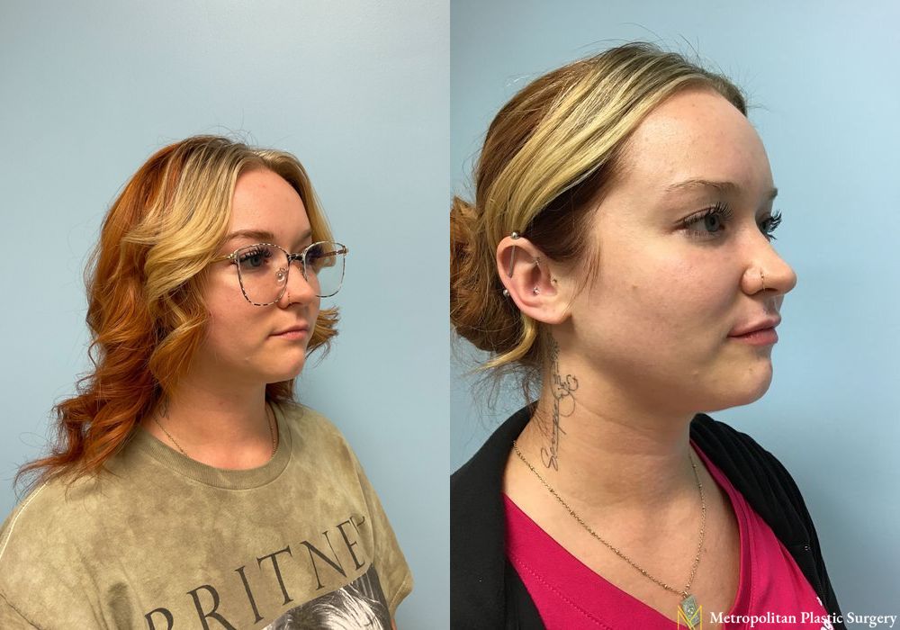 Fillers - Thumbnail 3