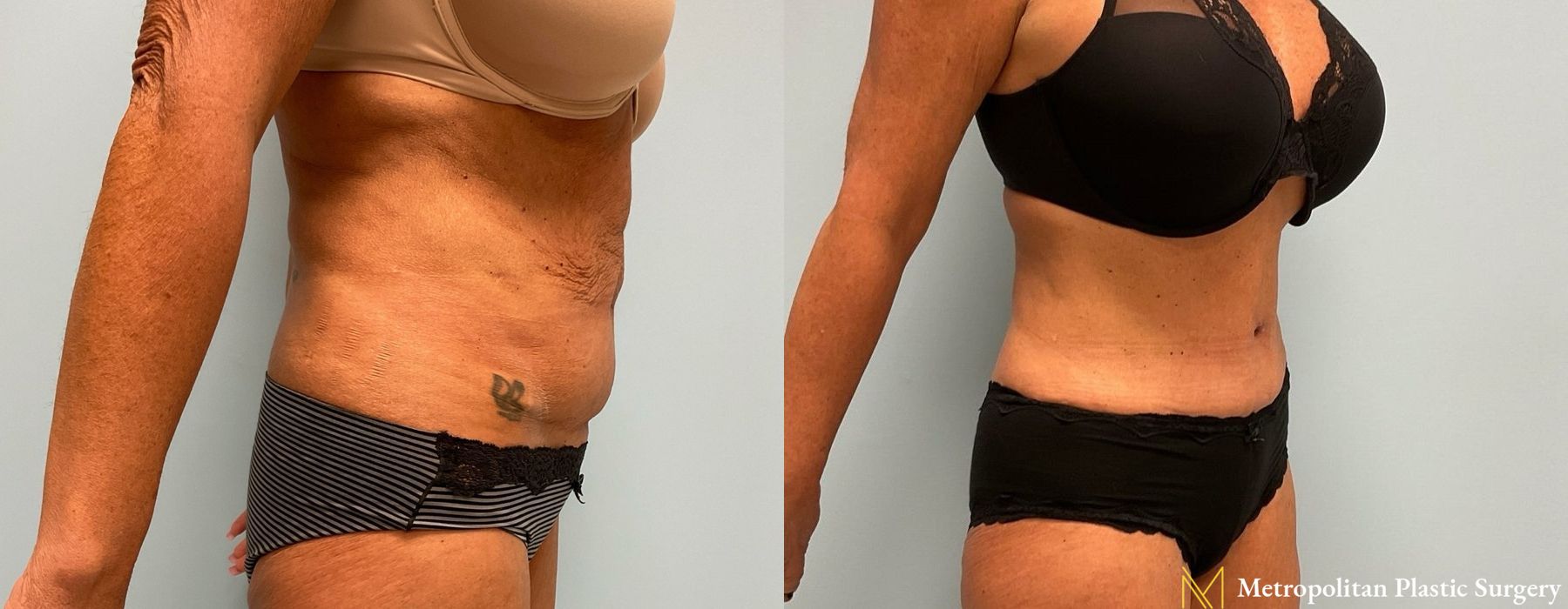 Abdominoplasty - Thumbnail 2