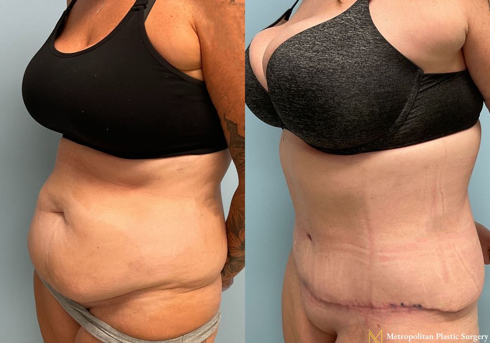 Abdominoplasty - Thumbnail 3