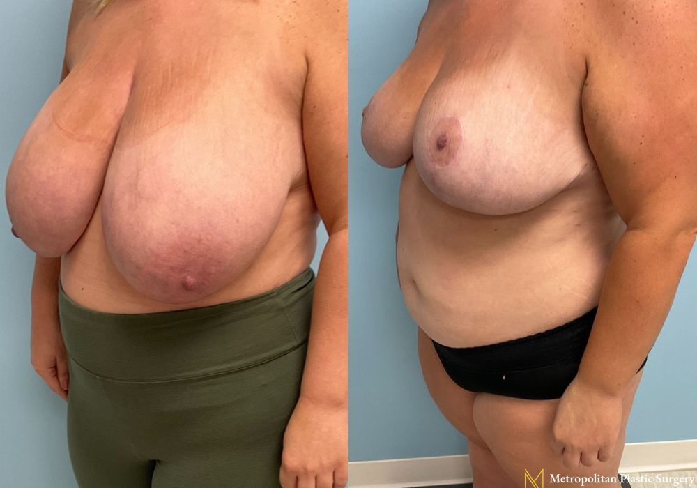 Breast Reduction - Thumbnail 4