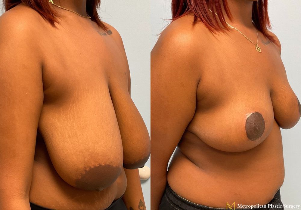 Breast Reduction - Thumbnail 4