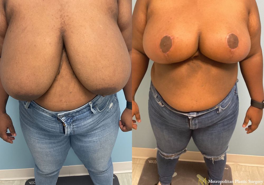 Breast Reduction - Thumbnail 3