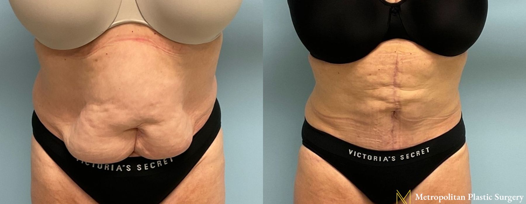 Abdominoplasty - Case 165