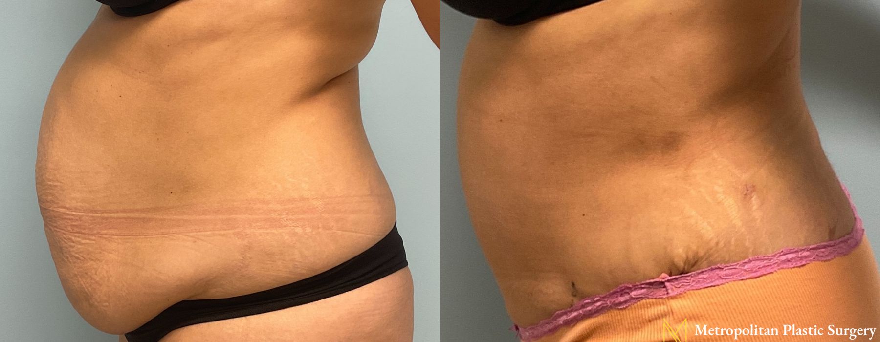 Liposuction - Thumbnail 4