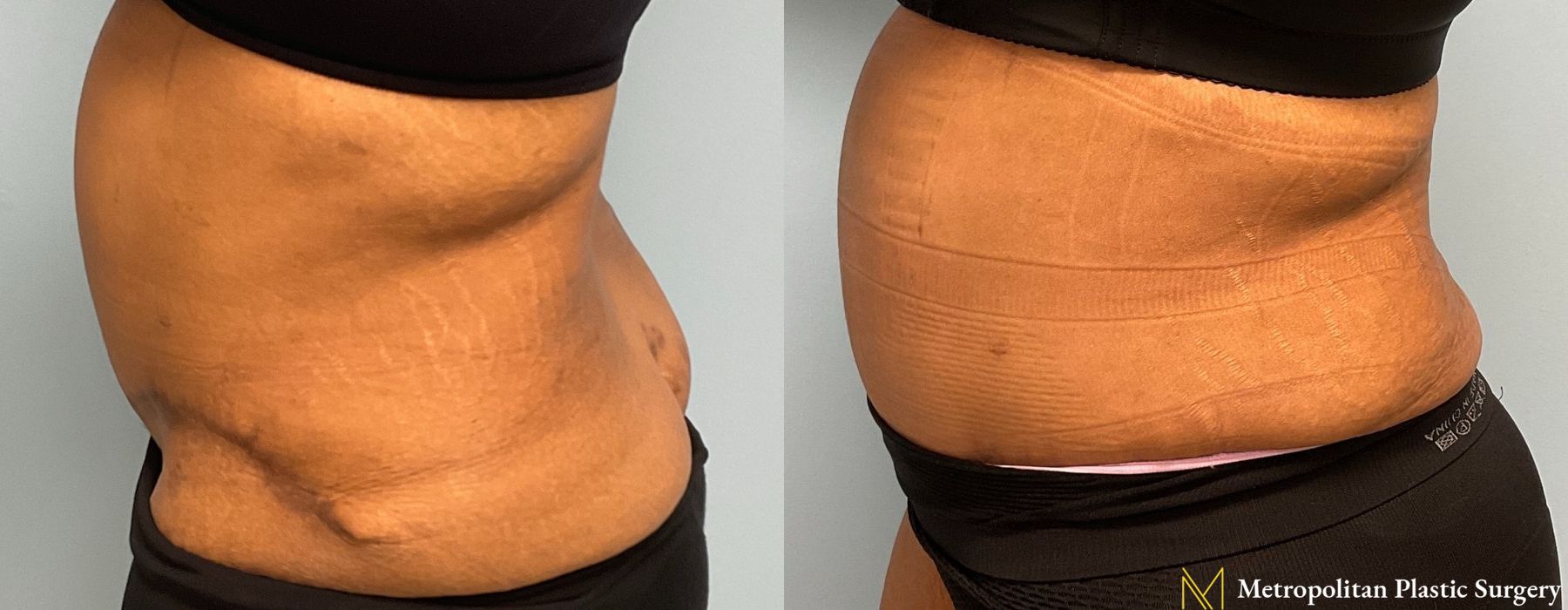 Liposuction - Thumbnail 4