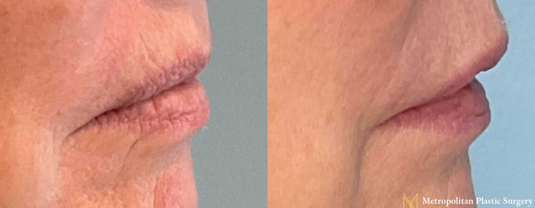 Fillers - Thumbnail 3