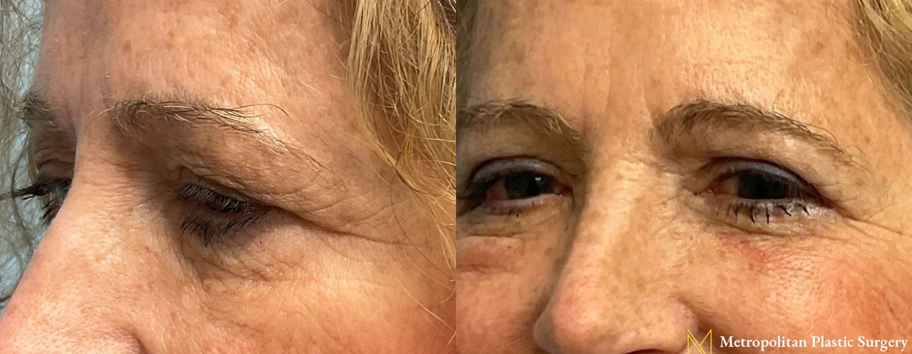 Blepharoplasty - Thumbnail 3