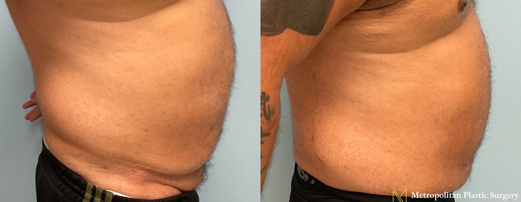 Liposuction - Thumbnail 2