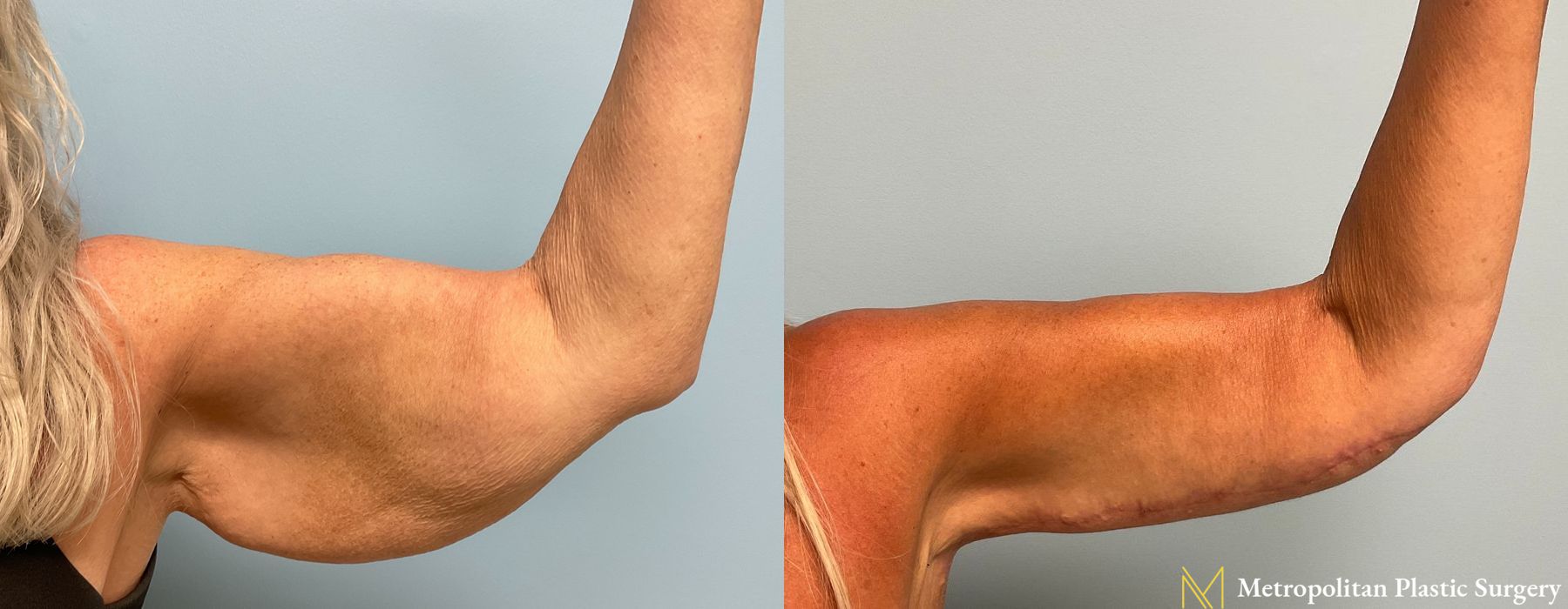 Brachioplasty - Thumbnail 2