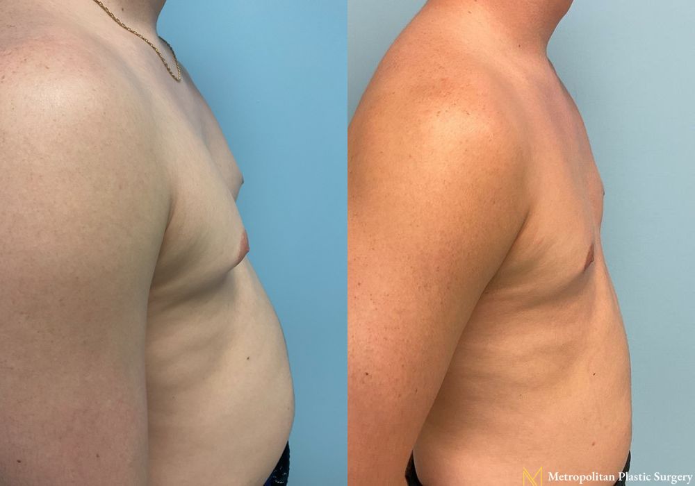 Gynecomastia - Thumbnail 2