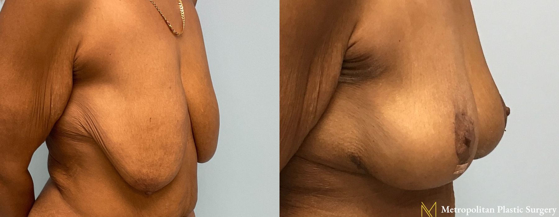 Breast Lift - Thumbnail 5