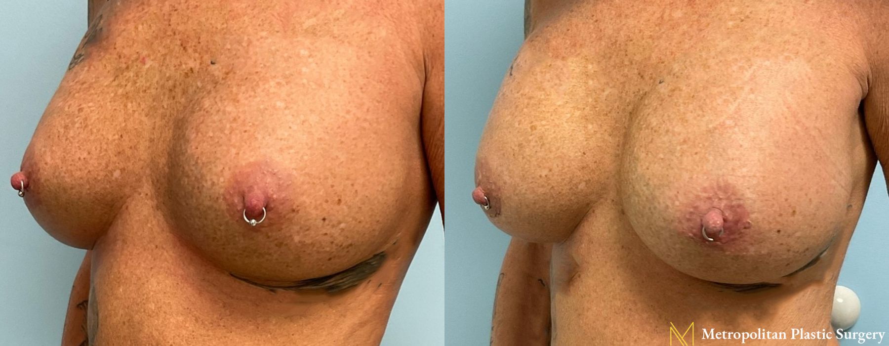 Breast Augmentation - Thumbnail 3