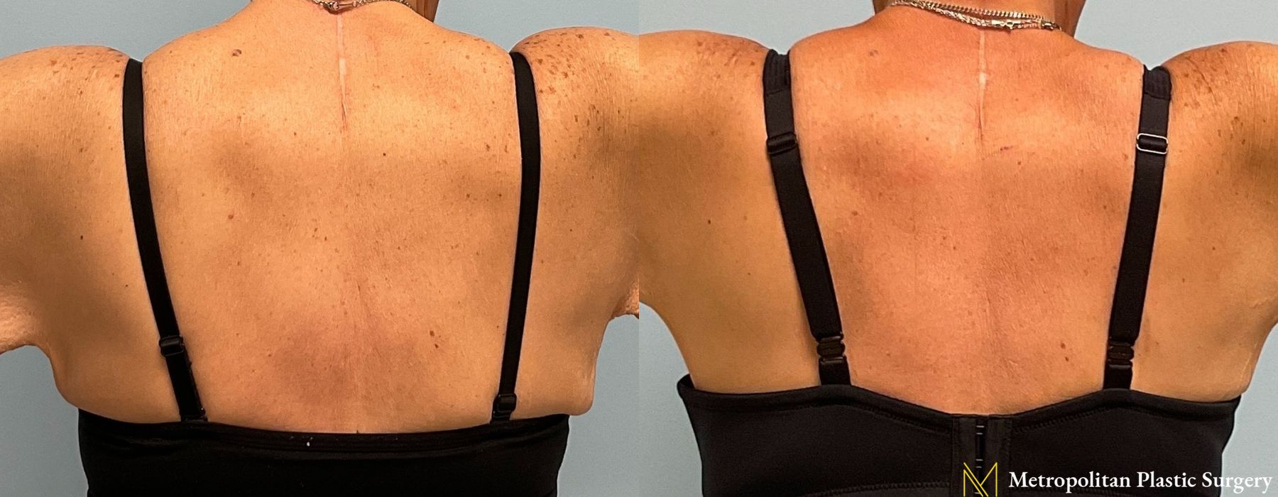 Brachioplasty - Case 81