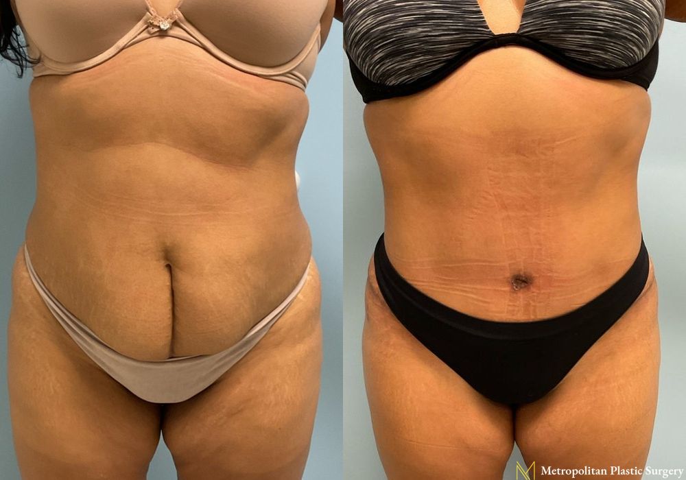 Abdominoplasty - Thumbnail 2