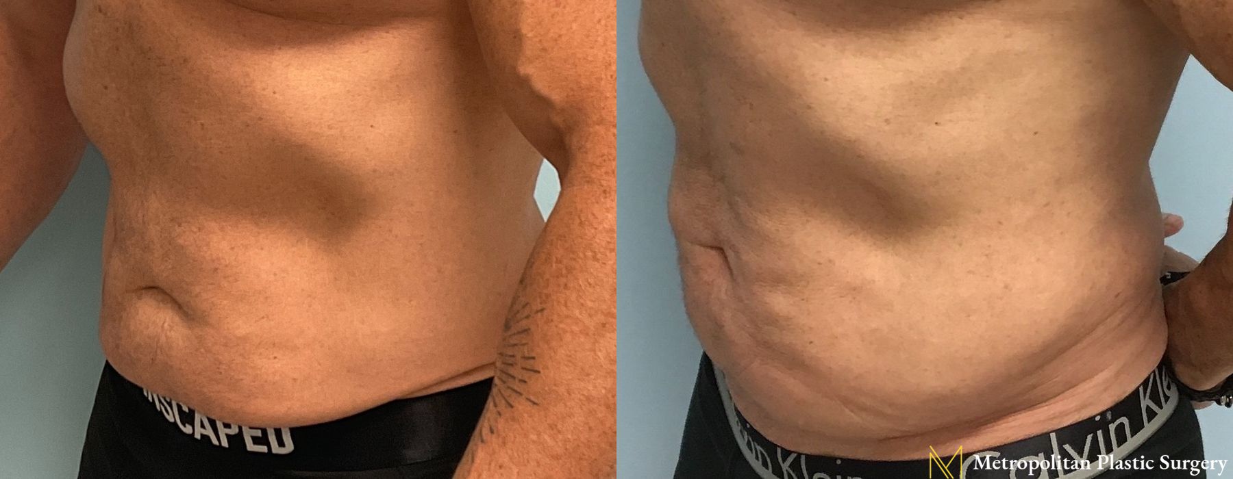 Liposuction - Thumbnail 3