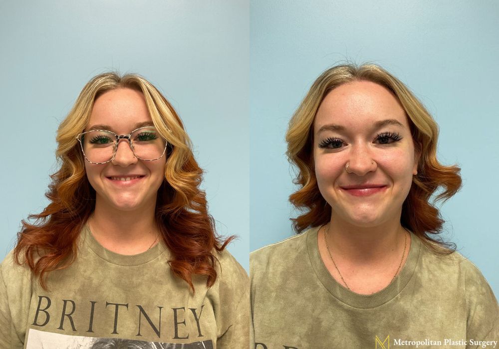 Fillers - Thumbnail 2