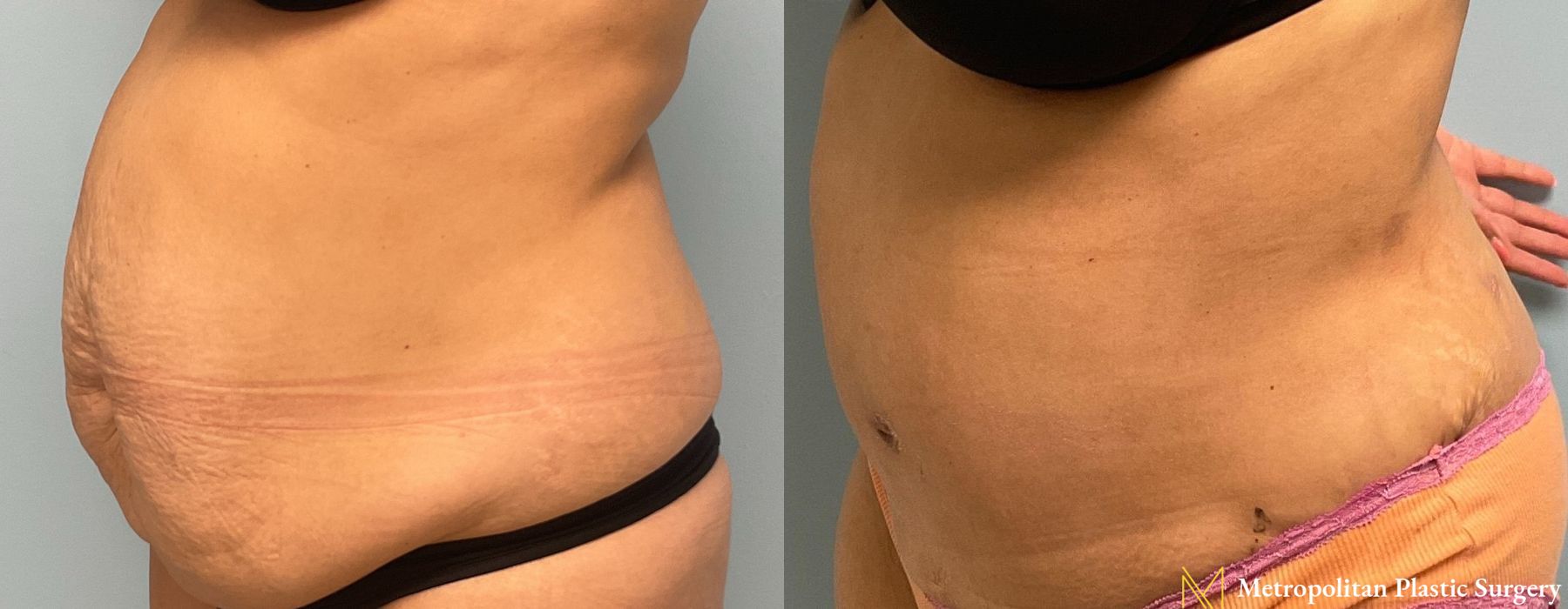 Liposuction - Thumbnail 3