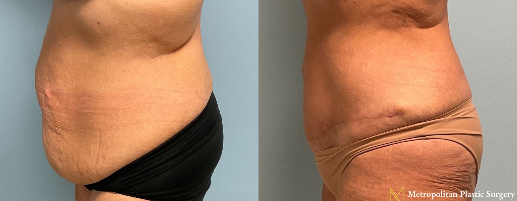 Abdominoplasty - Thumbnail 4