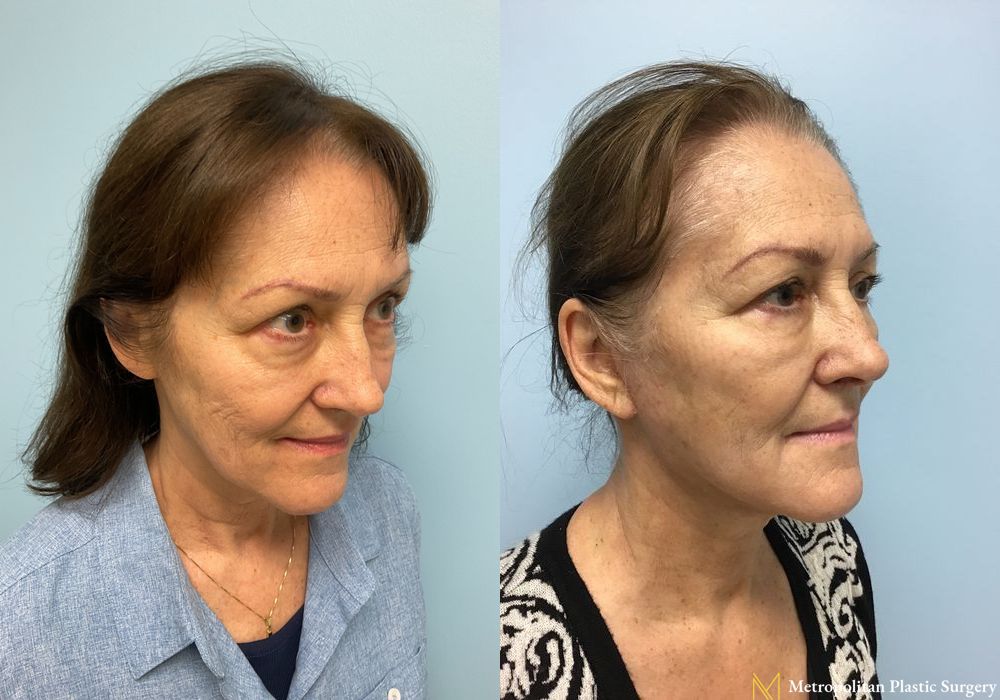 Facelift & Neck Lift - Thumbnail 3
