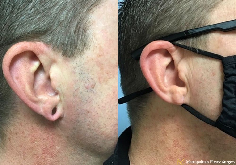 Earlobe Surgery - Thumbnail 2