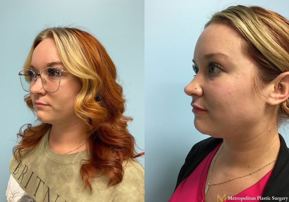 Fillers - Thumbnail 4