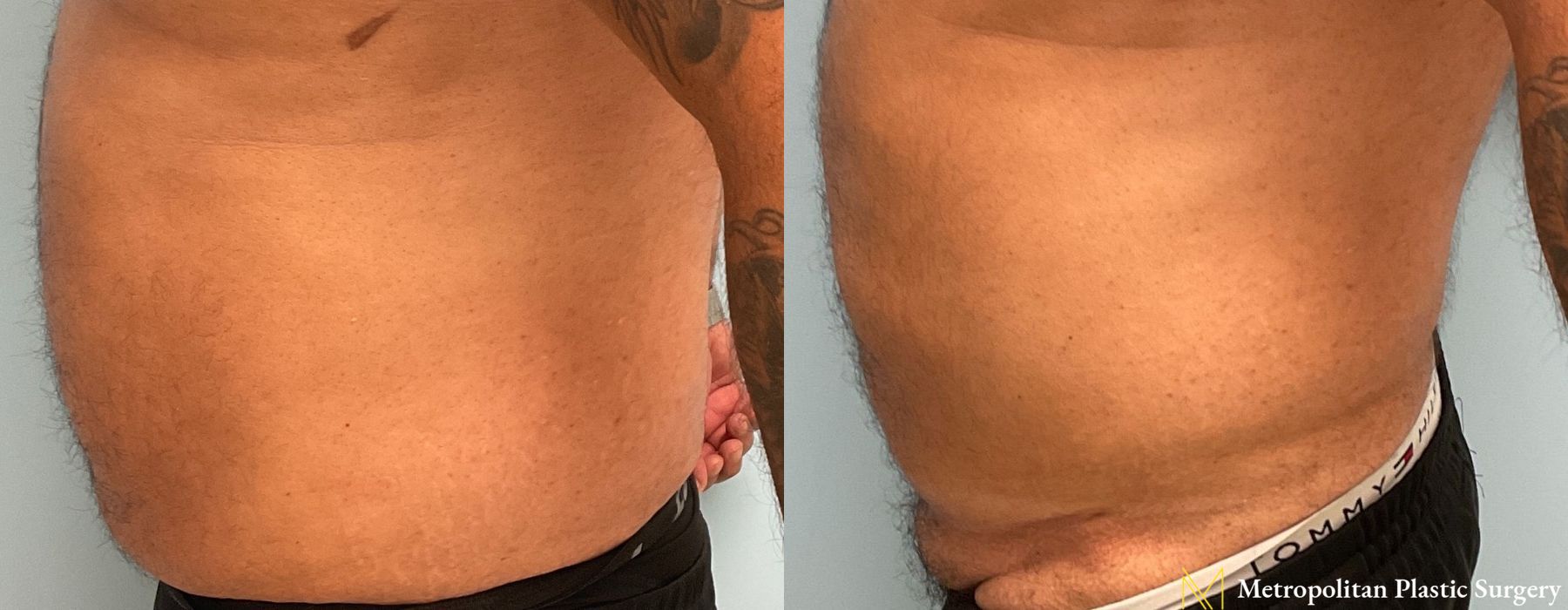 Liposuction - Thumbnail 4