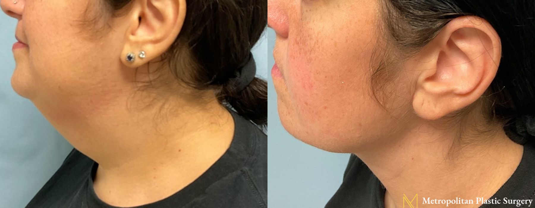Facelift & Neck Lift - Case 130