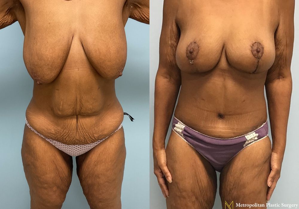 Abdominoplasty - Case 62