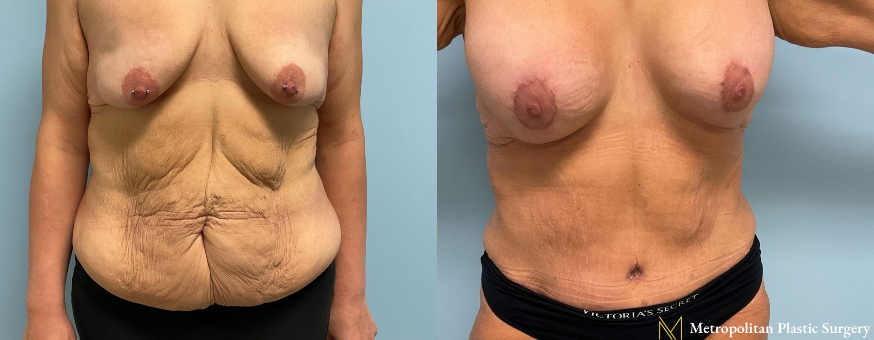 Abdominoplasty - Thumbnail 3