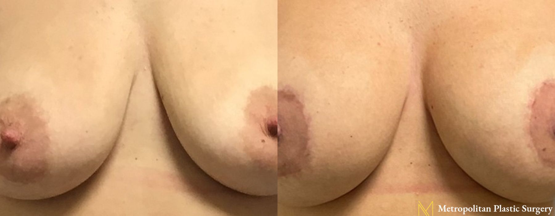 Breast Lift with Implants - Thumbnail 3
