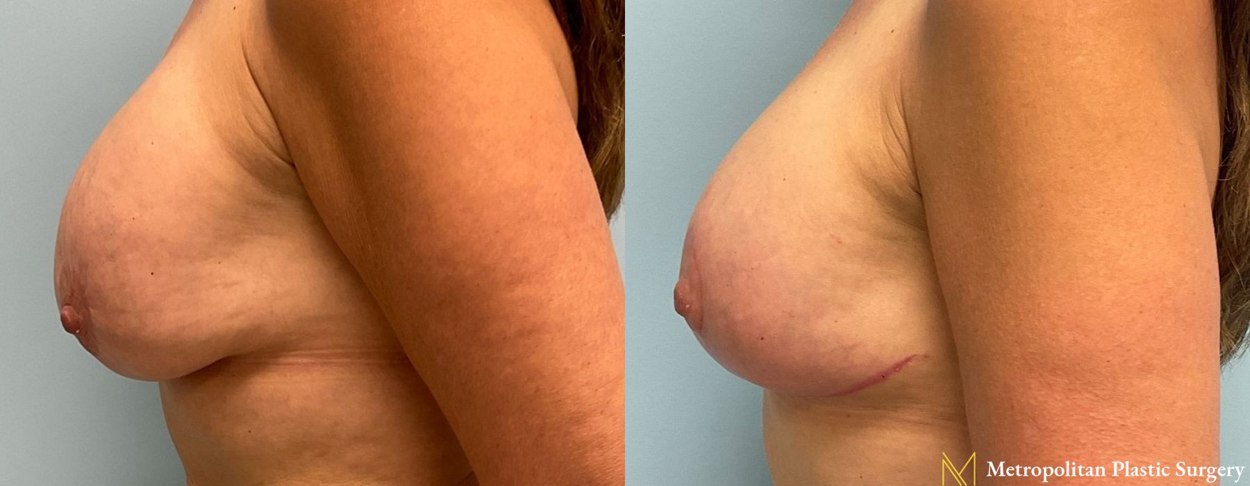 Breast Lift - Thumbnail 4