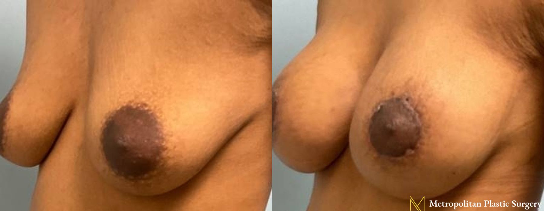 Breast Lift with Implants - Case 103