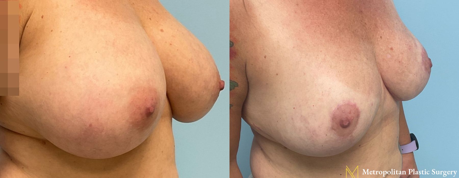 Breast Reduction - Thumbnail 2