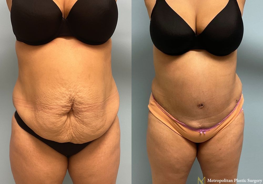 Abdominoplasty - Thumbnail 3