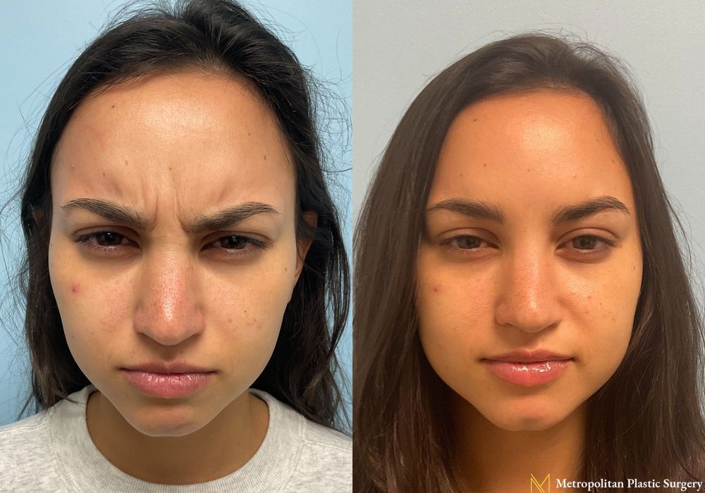 BOTOX® Cosmetic - Thumbnail 2