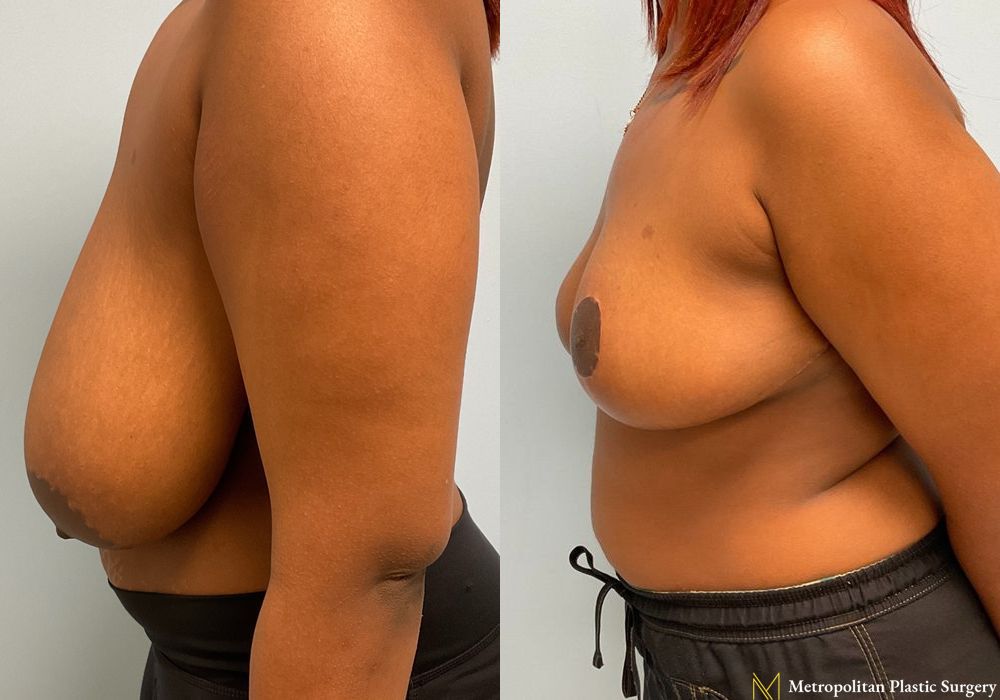 Breast Reduction - Thumbnail 5