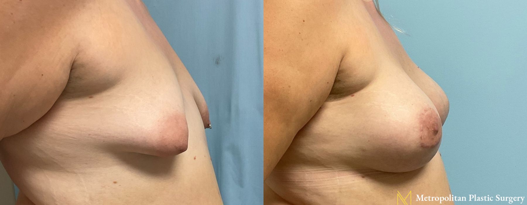 Breast Augmentation - Case 96
