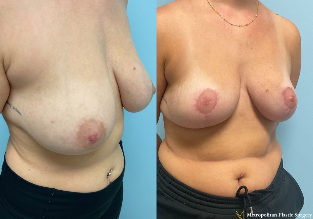 Breast Reduction - Thumbnail 4