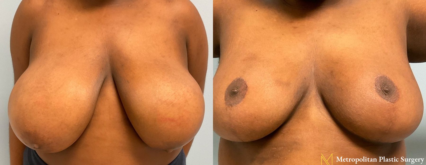 Breast Reduction - Case 110